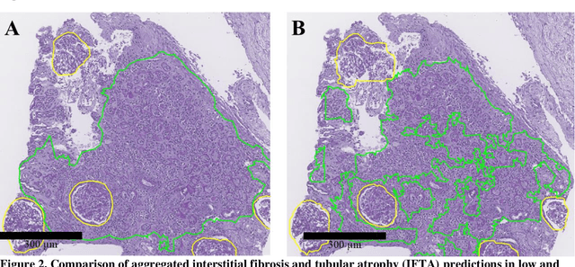 Figure 4 for Neural Network Segmentation of Interstitial Fibrosis, Tubular Atrophy, and Glomerulosclerosis in Renal Biopsies