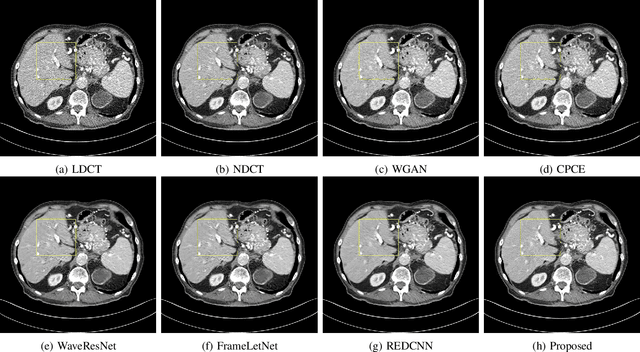 Figure 3 for Noise Conscious Training of Non Local Neural Network powered by Self Attentive Spectral Normalized Markovian Patch GAN for Low Dose CT Denoising