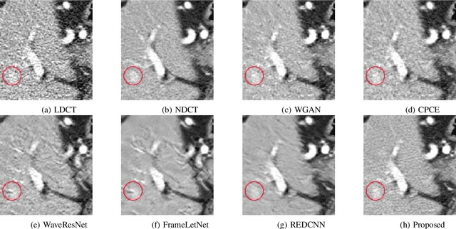 Figure 4 for Noise Conscious Training of Non Local Neural Network powered by Self Attentive Spectral Normalized Markovian Patch GAN for Low Dose CT Denoising