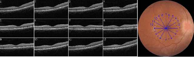 Figure 1 for Lesion Localization in OCT by Semi-Supervised Object Detection
