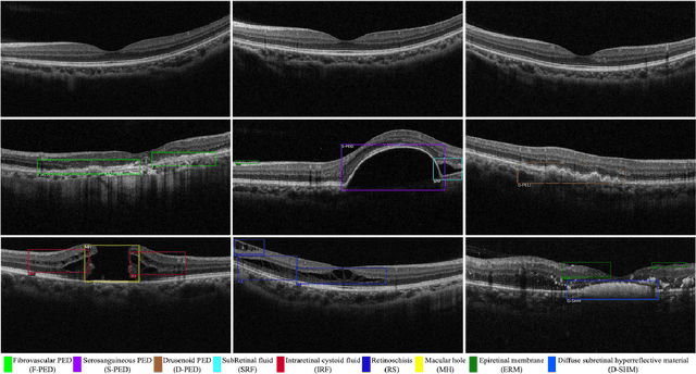 Figure 3 for Lesion Localization in OCT by Semi-Supervised Object Detection