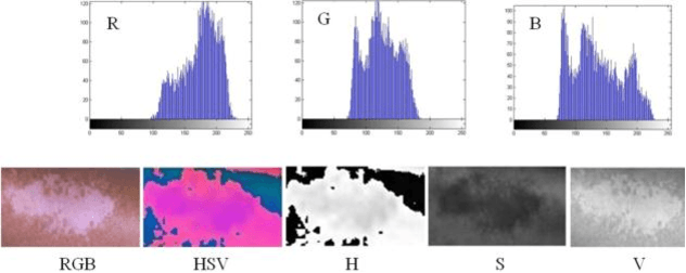 Figure 4 for A New Approach for Automatic Segmentation and Evaluation of Pigmentation Lesion by using Active Contour Model and Speeded Up Robust Features