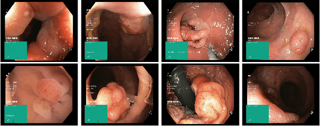 Figure 2 for Medico Multimedia Task at MediaEval 2020: Automatic Polyp Segmentation