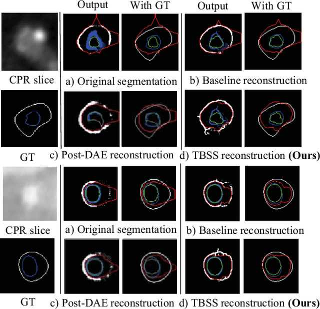 Figure 4 for Plaque segmentation via masking of the artery wall