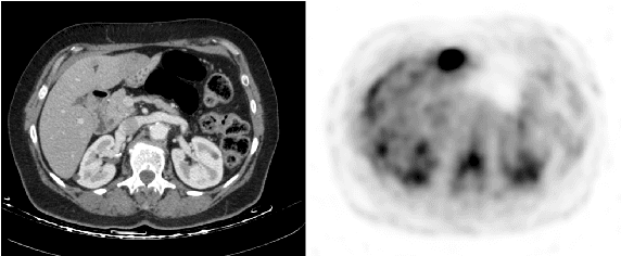 Figure 1 for Cross-Modality Synthesis from CT to PET using FCN and GAN Networks for Improved Automated Lesion Detection