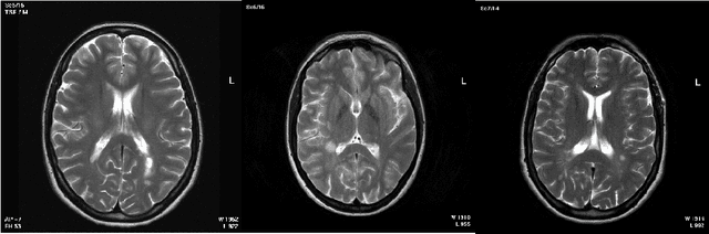 Figure 1 for Segmentation of Multiple Sclerosis lesion in brain MR images using Fuzzy C-Means