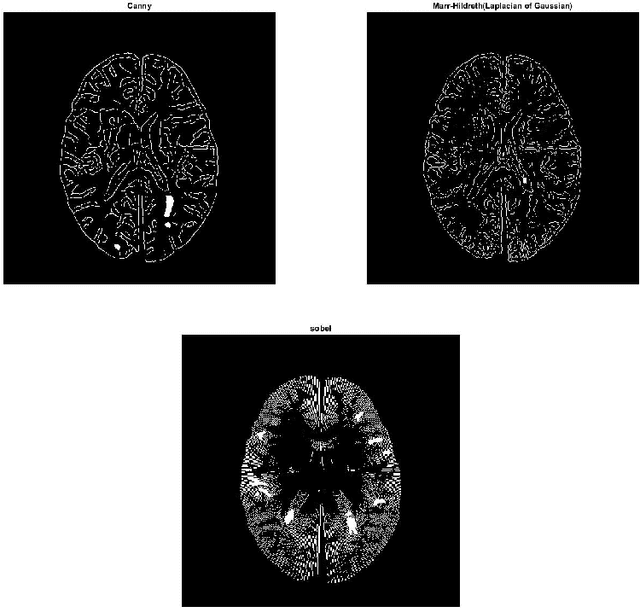 Figure 2 for Segmentation of Multiple Sclerosis lesion in brain MR images using Fuzzy C-Means