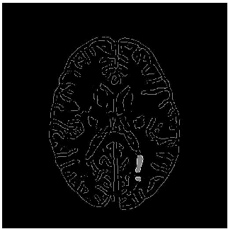 Figure 3 for Segmentation of Multiple Sclerosis lesion in brain MR images using Fuzzy C-Means