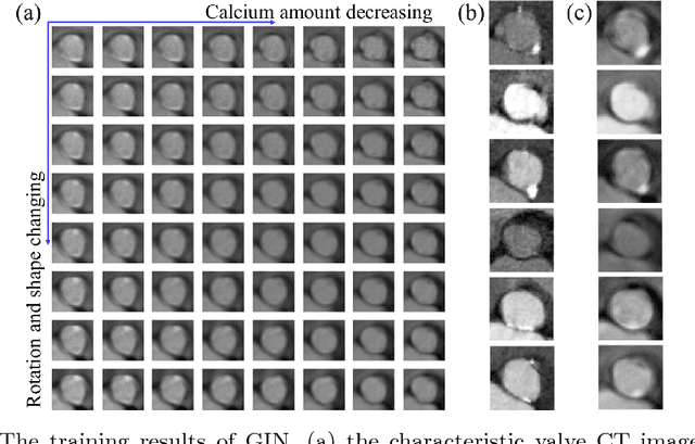 Figure 2 for Generative Invertible Networks (GIN): Pathophysiology-Interpretable Feature Mapping and Virtual Patient Generation