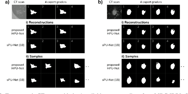 Figure 3 for A Hierarchical Probabilistic U-Net for Modeling Multi-Scale Ambiguities