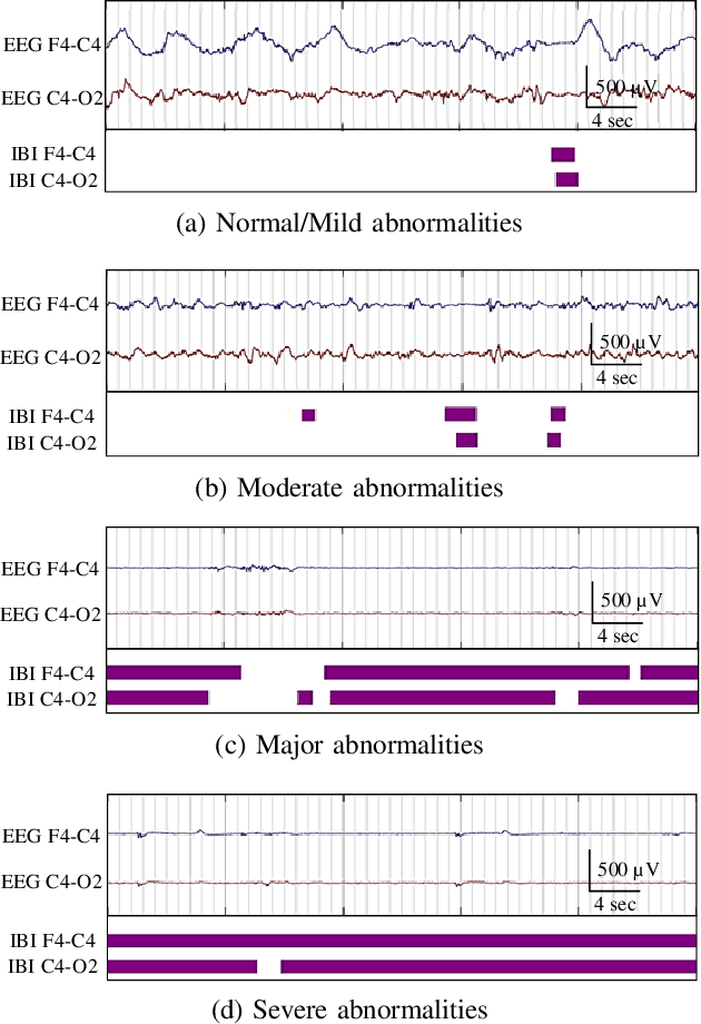 Figure 2 for Suitability of an inter-burst detection method for grading hypoxic-ischemic encephalopathy in newborn EEG