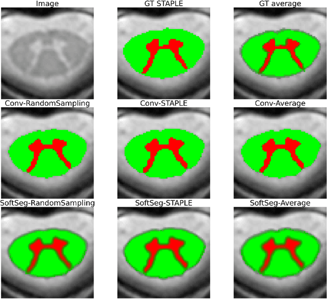Figure 4 for Label fusion and training methods for reliable representation of inter-rater uncertainty