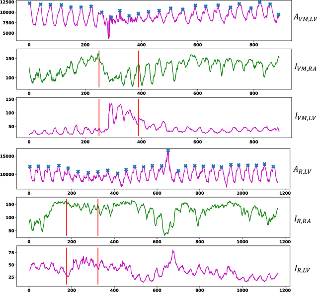 Figure 3 for EchoCP: An Echocardiography Dataset in Contrast Transthoracic Echocardiography for Patent Foramen Ovale Diagnosis