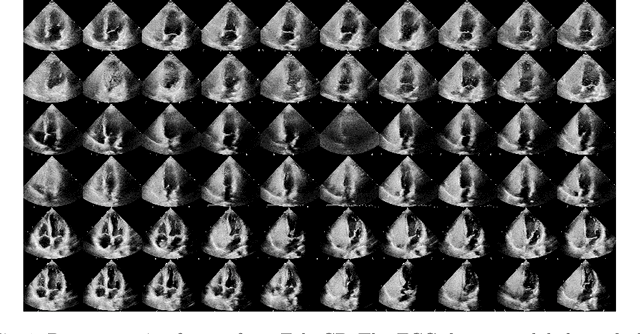 Figure 2 for EchoCP: An Echocardiography Dataset in Contrast Transthoracic Echocardiography for Patent Foramen Ovale Diagnosis