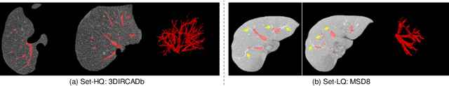 Figure 1 for Noisy Labels are Treasure: Mean-Teacher-Assisted Confident Learning for Hepatic Vessel Segmentation