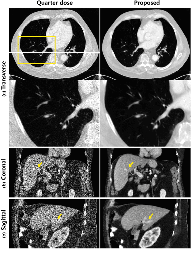 Figure 2 for A deep convolutional neural network using directional wavelets for low-dose X-ray CT reconstruction