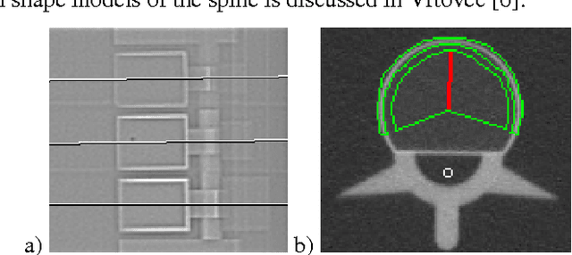 Figure 1 for A New 3D Method to Segment the Lumbar Vertebral Bodies and to Determine Bone Mineral Density and Geometry