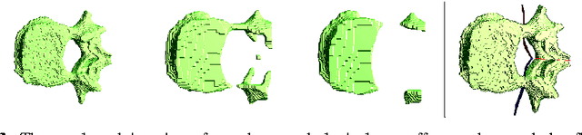 Figure 4 for A New 3D Method to Segment the Lumbar Vertebral Bodies and to Determine Bone Mineral Density and Geometry