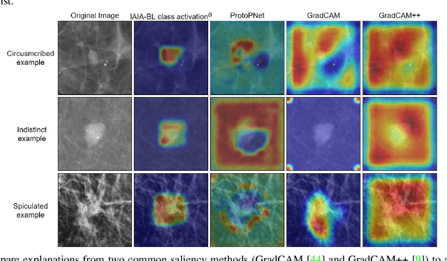 Figure 3 for IAIA-BL: A Case-based Interpretable Deep Learning Model for Classification of Mass Lesions in Digital Mammography