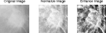 Figure 4 for Density-Wise Two Stage Mammogram Classification using Texture Exploiting Descriptors