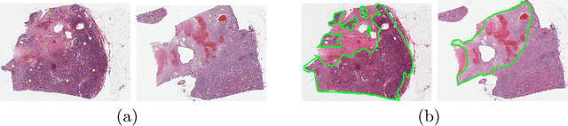 Figure 1 for Renal Cell Carcinoma Detection and Subtyping with Minimal Point-Based Annotation in Whole-Slide Images