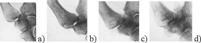 Figure 2 for An Application of Backpropagation Artificial Neural Network Method for Measuring The Severity of Osteoarthritis