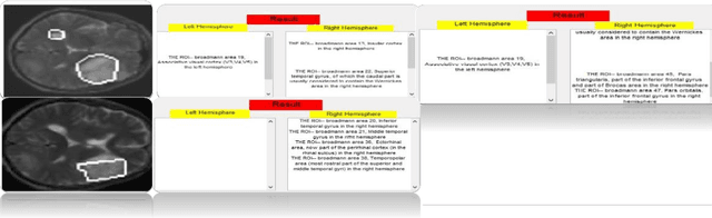 Figure 4 for Automated Tumor Segmentation and Brain Mapping for the Tumor Area