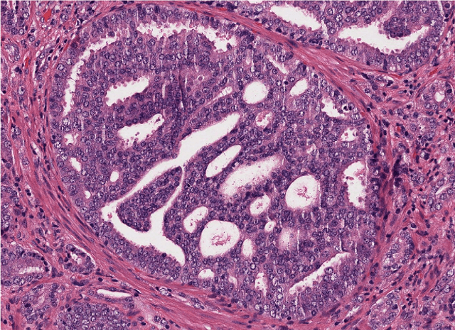 Figure 4 for Large scale digital prostate pathology image analysis combining feature extraction and deep neural network