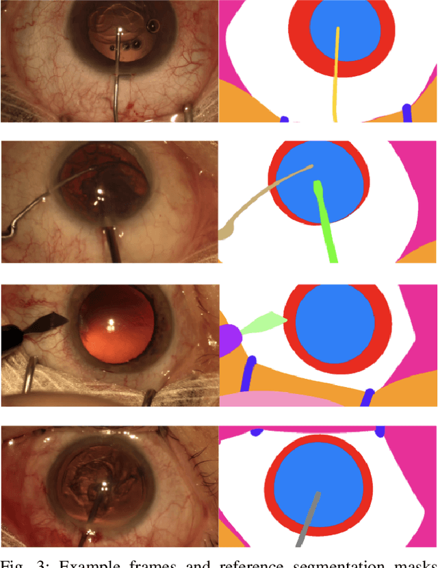 Figure 3 for 2020 CATARACTS Semantic Segmentation Challenge