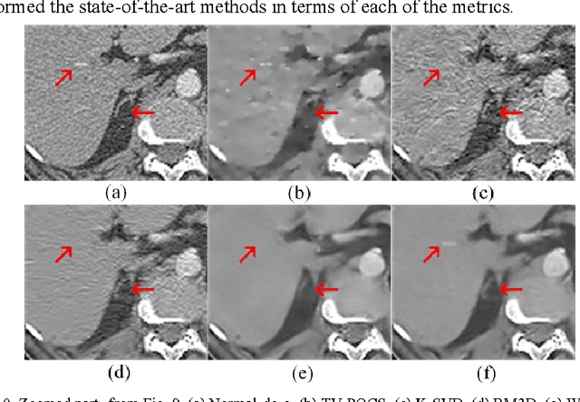 Figure 1 for Low-Dose CT with a Residual Encoder-Decoder Convolutional Neural Network
