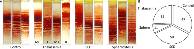 Figure 3 for Fourier Transform of Percoll Gradients Boosts CNN Classification of Hereditary Hemolytic Anemias