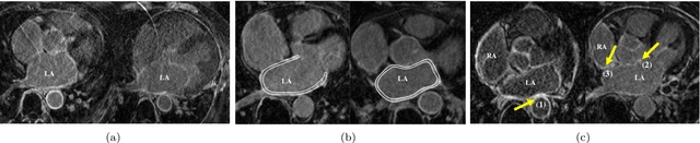 Figure 1 for Atrial Scar Quantification via Multi-scale CNN in the Graph-cuts Framework