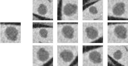 Figure 3 for GAN-based Synthetic Medical Image Augmentation for increased CNN Performance in Liver Lesion Classification