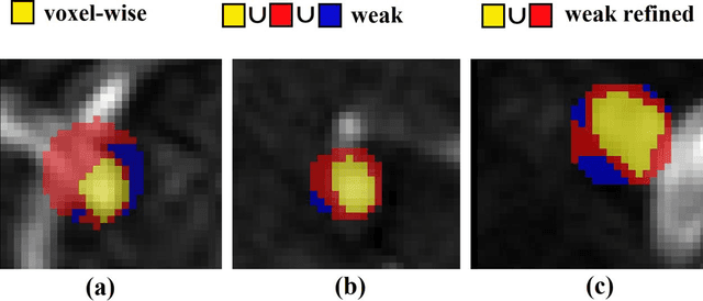 Figure 4 for Weak labels and anatomical knowledge: making deep learning practical for intracranial aneurysm detection in TOF-MRA