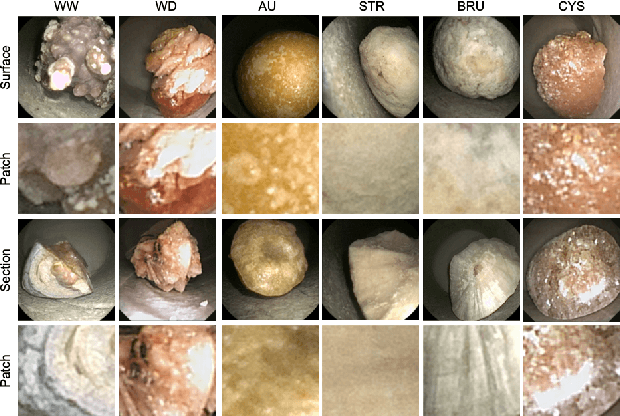 Figure 2 for Comparing feature fusion strategies for Deep Learning-based kidney stone identification
