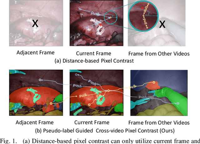 Figure 1 for Pseudo-label Guided Cross-video Pixel Contrast for Robotic Surgical Scene Segmentation with Limited Annotations