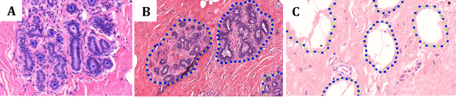 Figure 1 for Deep learning assessment of breast terminal duct lobular unit involution: towards automated prediction of breast cancer risk