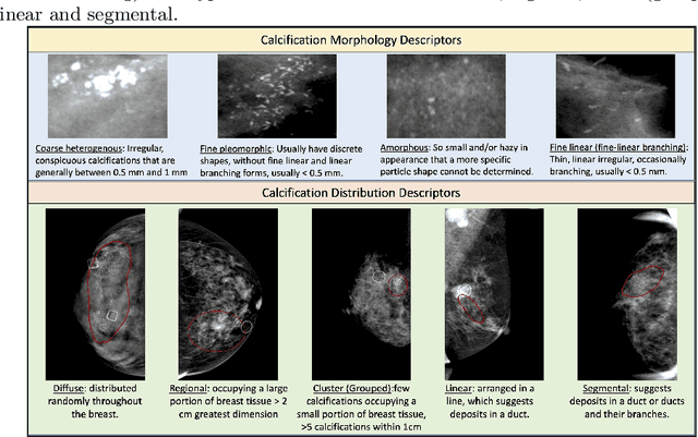 Figure 1 for Multi-task Graph Convolutional Neural Network for Calcification Morphology and Distribution Analysis in Mammograms