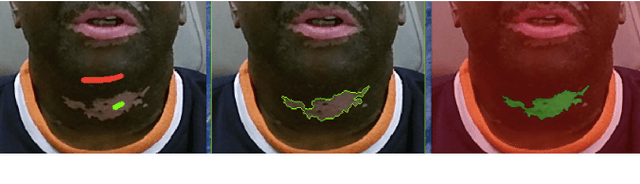 Figure 3 for Automating Vitiligo Skin Lesion Segmentation Using Convolutional Neural Networks