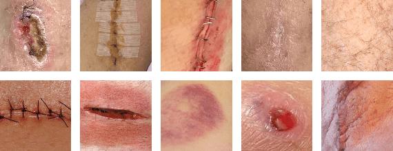 Figure 1 for Deepwound: Automated Postoperative Wound Assessment and Surgical Site Surveillance through Convolutional Neural Networks