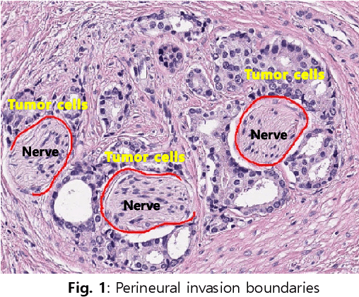 Figure 1 for Perineural Invasion Detection in Multiple Organ Cancer Based on Deep Convolutional Neural Network