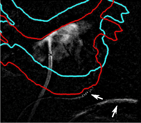 Figure 1 for 3-D/2-D Registration of Cardiac Structures by 3-D Contrast Agent Distribution Estimation