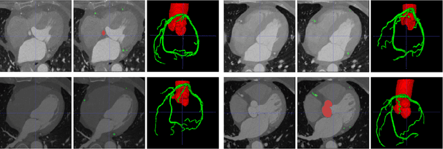 Figure 2 for Deep 3D Vessel Segmentation based on Cross Transformer Network