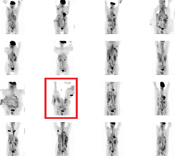 Figure 4 for RADIOGAN: Deep Convolutional Conditional Generative adversarial Network To Generate PET Images