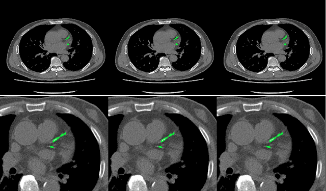 Figure 4 for Automatic Calcium Scoring in Cardiac and Chest CT Using DenseRAUnet