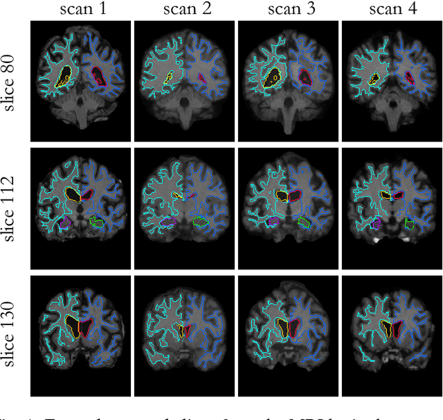 Figure 1 for VoxelMorph: A Learning Framework for Deformable Medical Image Registration