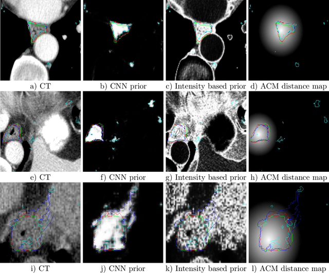Figure 2 for A 3D fully convolutional neural network and a random walker to segment the esophagus in CT