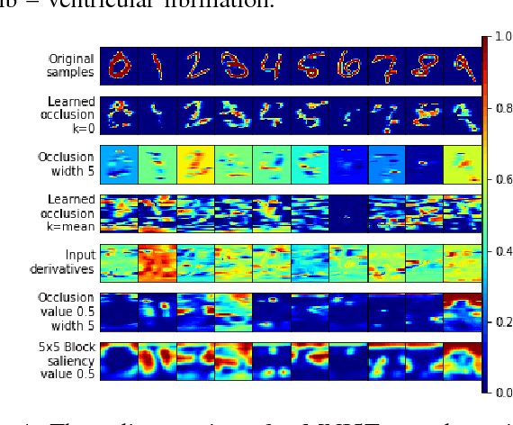 Figure 4 for Techniques for visualizing LSTMs applied to electrocardiograms