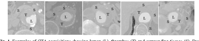 Figure 1 for Aorta Segmentation for Stent Simulation