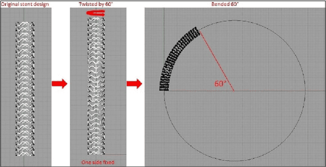Figure 1 for Patient-Specific 3D Volumetric Reconstruction of Bioresorbable Stents: A Method to Generate 3D Geometries for Computational Analysis of Coronaries Treated with Bioresorbable Stents